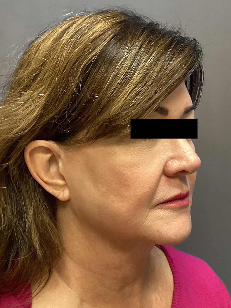 FACELIFT Before & After Gallery - Patient 192089 - Image 3