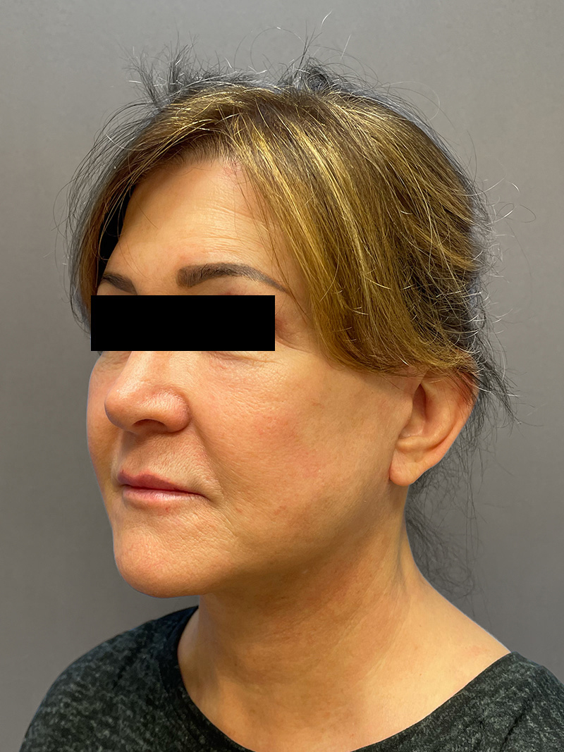 FACELIFT Before & After Gallery - Patient 192089 - Image 10