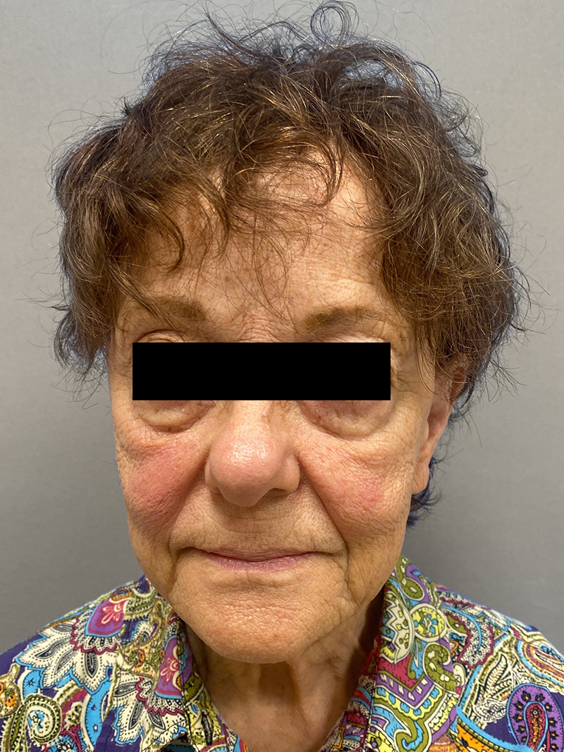 FACELIFT Before & After Gallery - Patient 263225 - Image 1