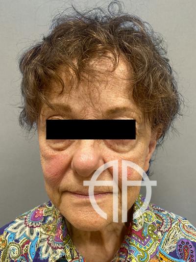 FACELIFT Before & After Gallery - Patient 263225 - Image 1