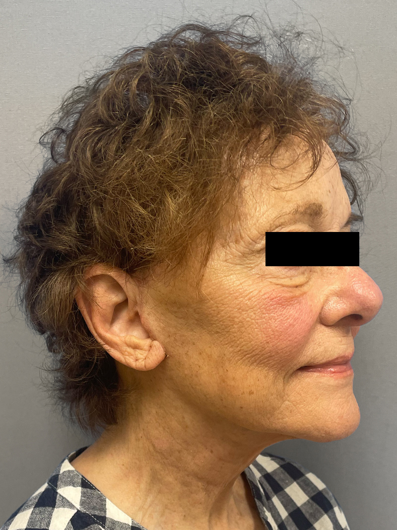 FACELIFT Before & After Gallery - Patient 263225 - Image 4