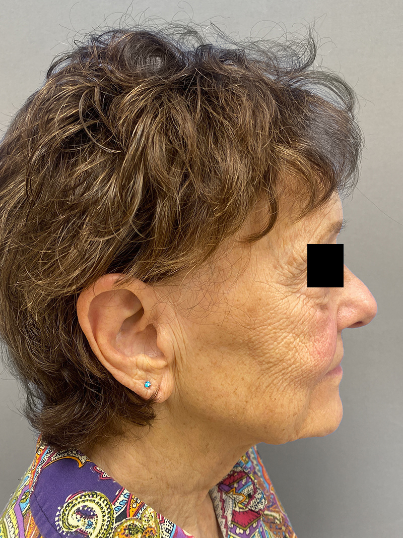FACELIFT Before & After Gallery - Patient 263225 - Image 6