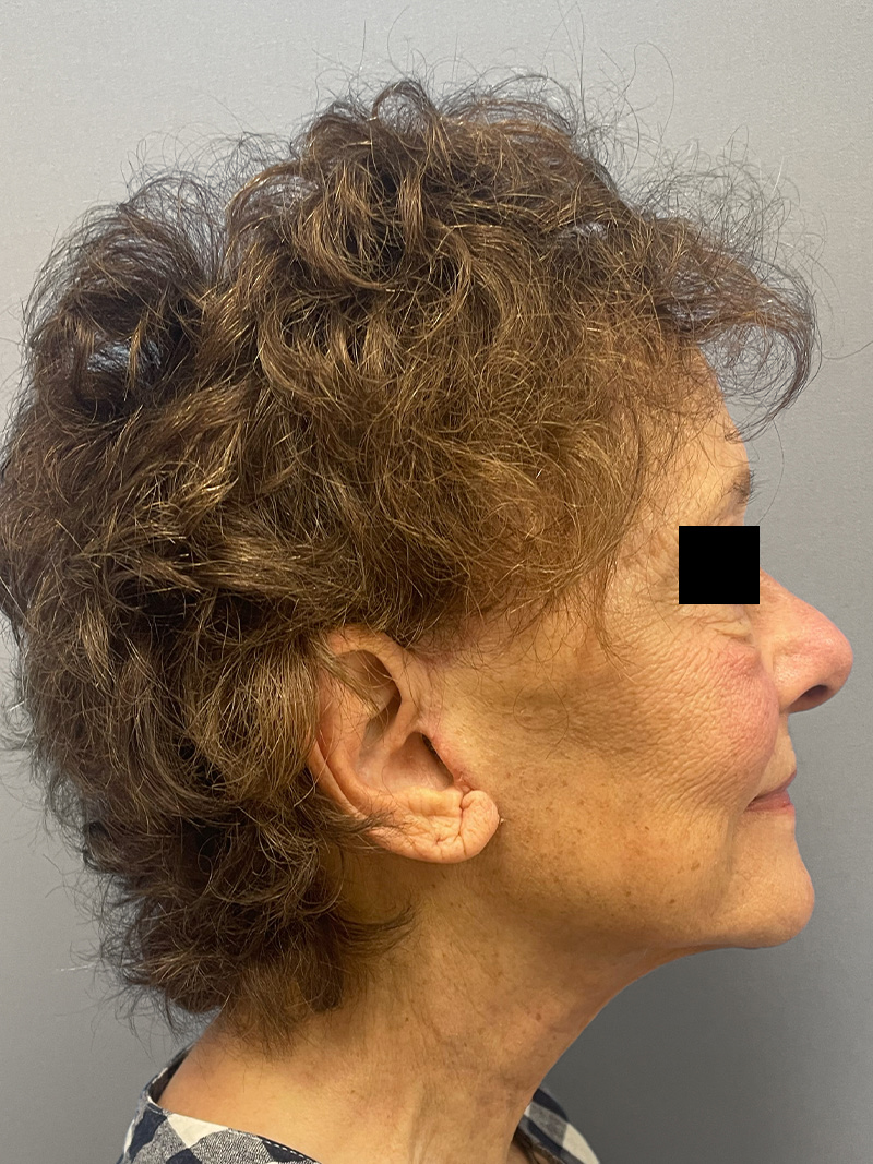 FACELIFT Before & After Gallery - Patient 263225 - Image 5