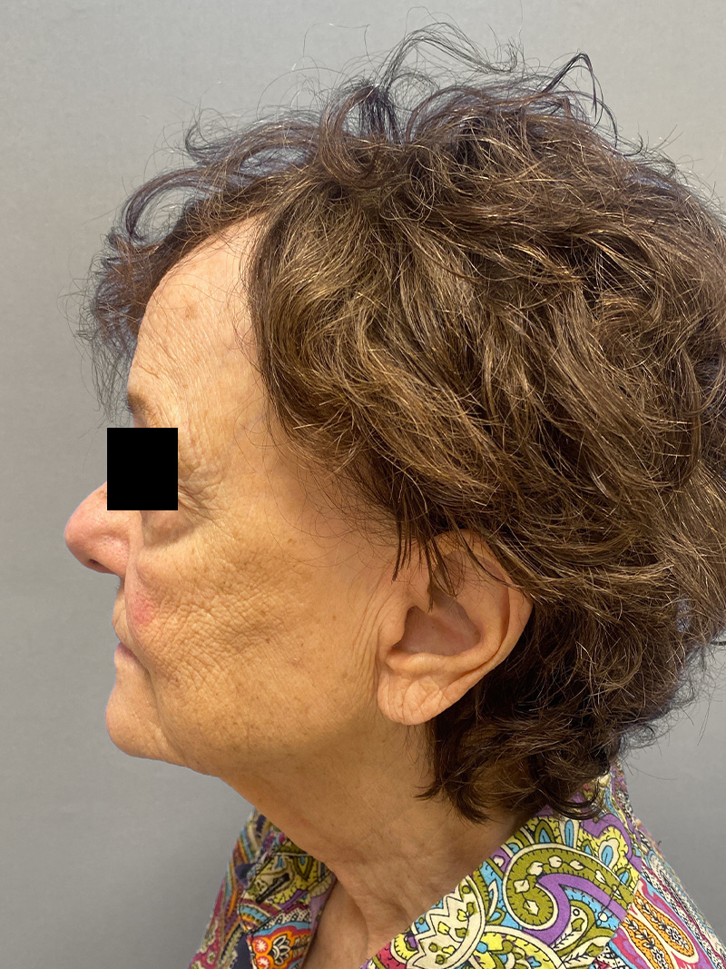 FACELIFT Before & After Gallery - Patient 263225 - Image 9