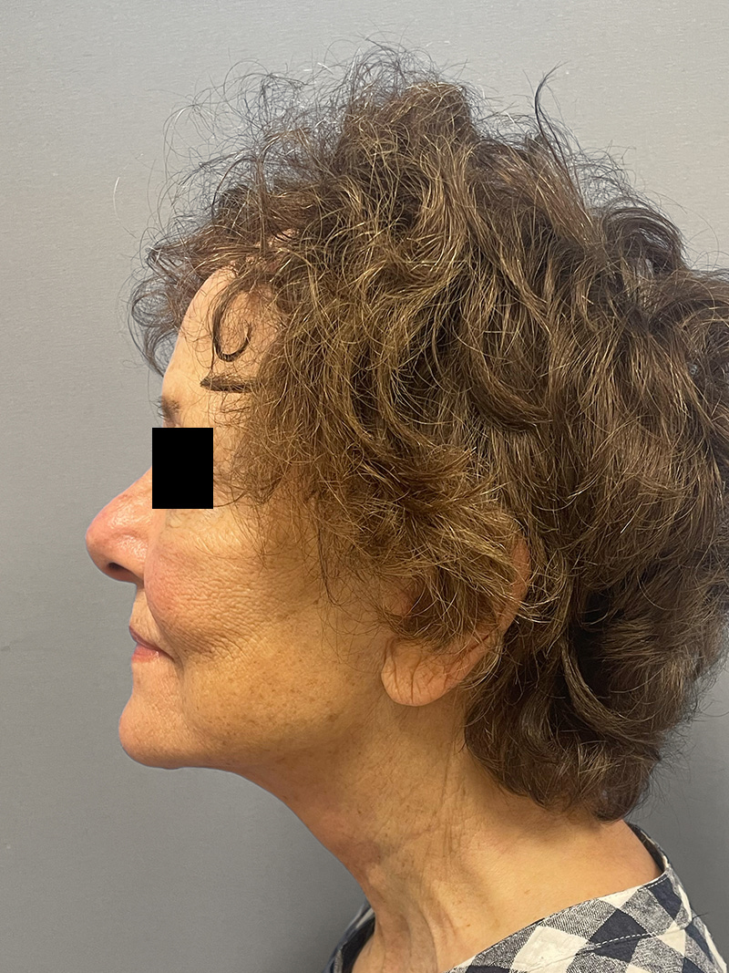 FACELIFT Before & After Gallery - Patient 263225 - Image 10