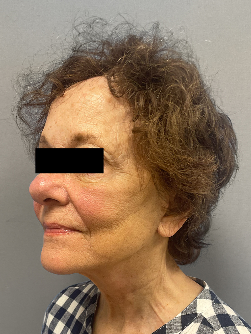 FACELIFT Before & After Gallery - Patient 263225 - Image 8