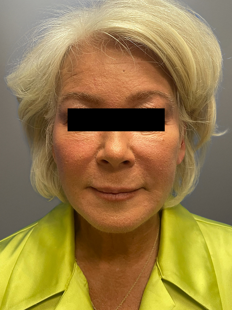 FACELIFT Before & After Gallery - Patient 265475 - Image 2