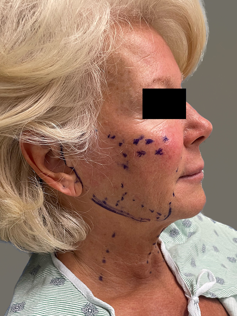 FACELIFT Before & After Gallery - Patient 265475 - Image 5