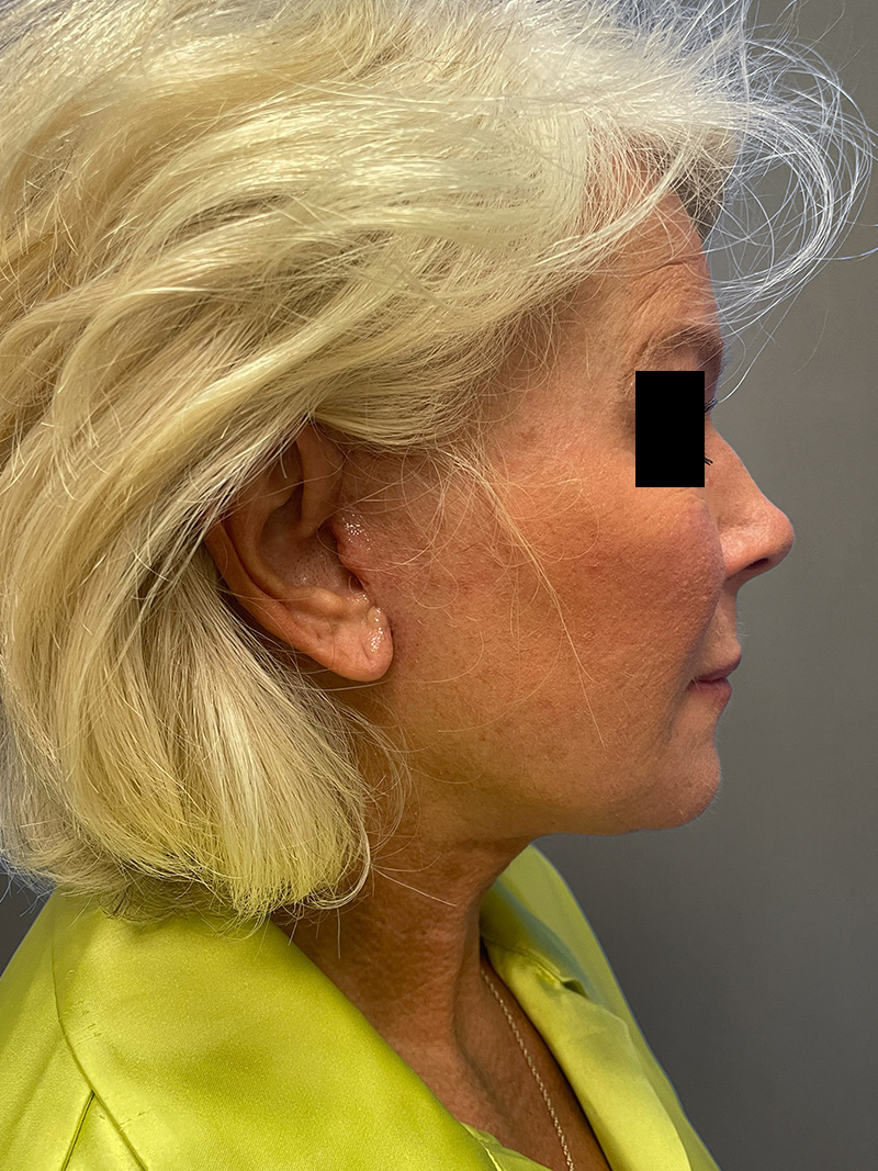 FACELIFT Before & After Gallery - Patient 265475 - Image 6