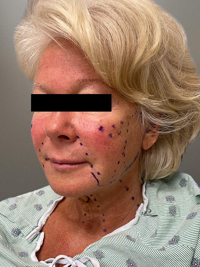 FACELIFT Before & After Gallery - Patient 265475 - Image 9