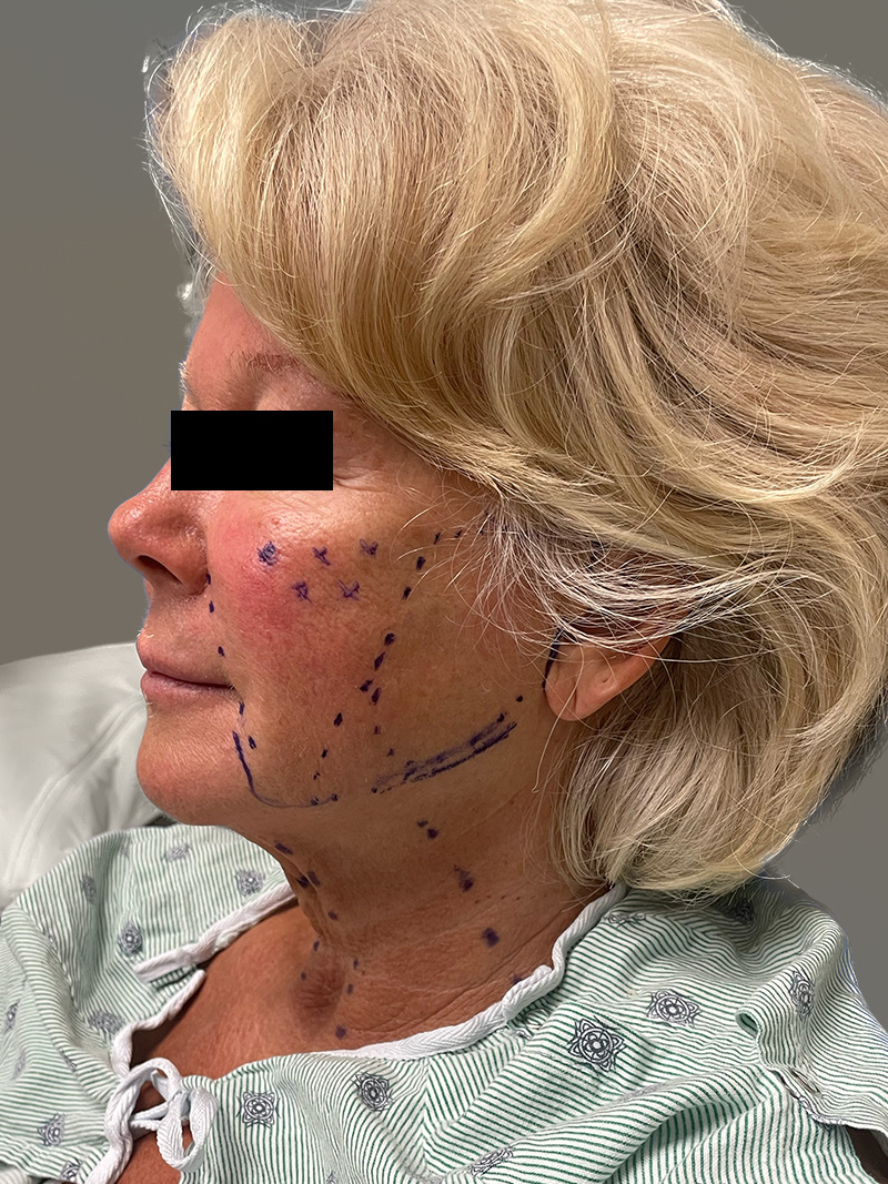 FACELIFT Before & After Gallery - Patient 265475 - Image 7