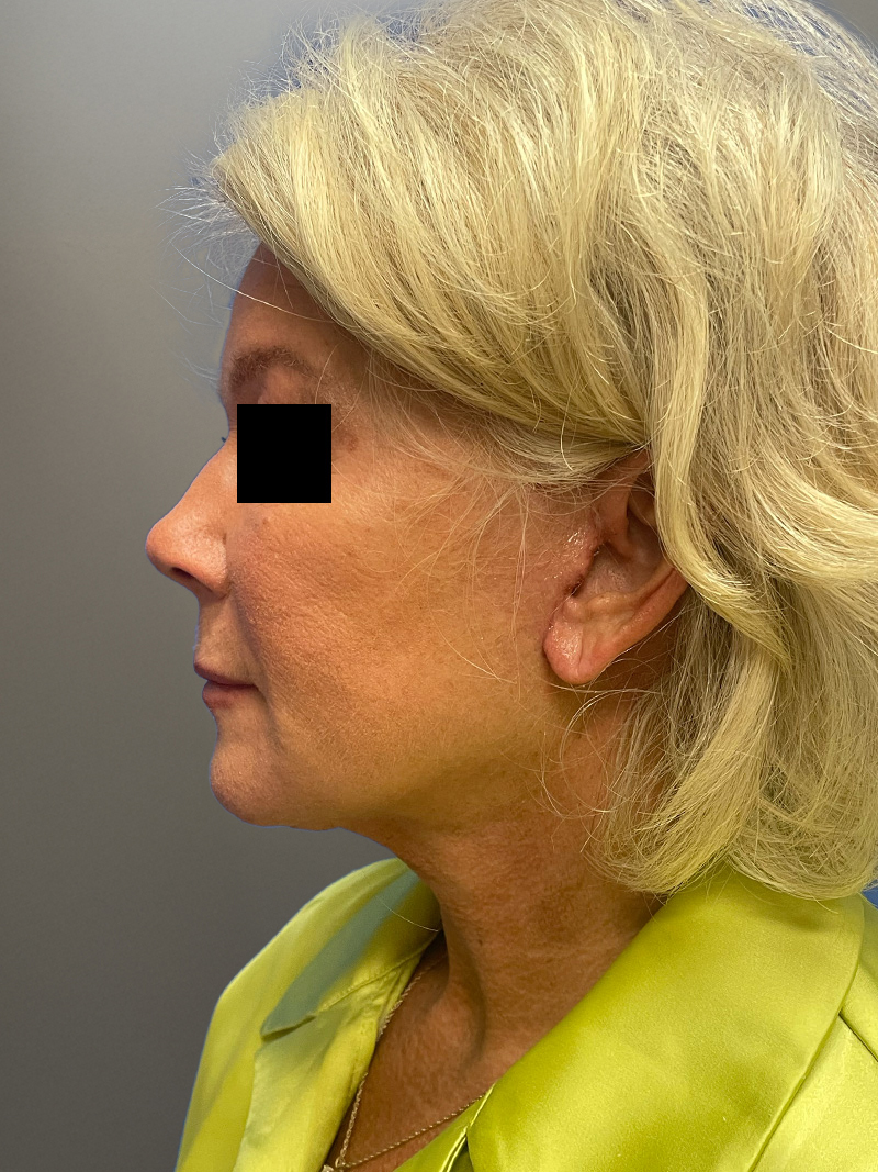 FACELIFT Before & After Gallery - Patient 265475 - Image 8