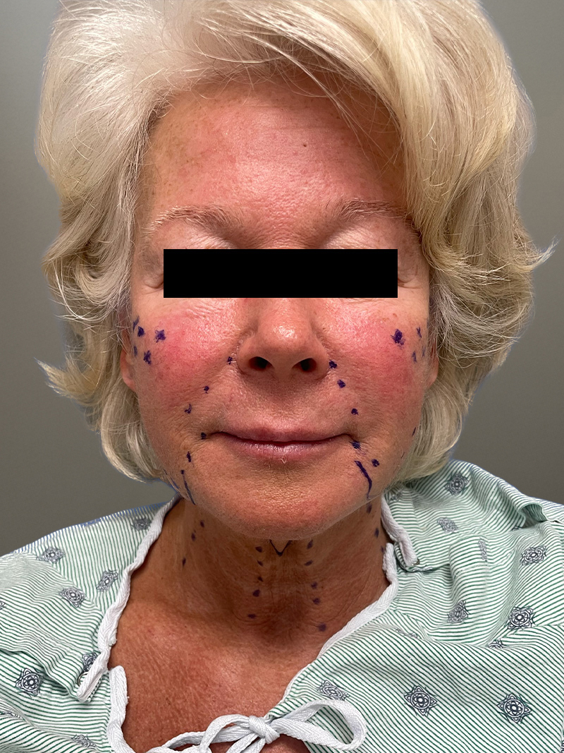 FACELIFT Before & After Gallery - Patient 265475 - Image 1