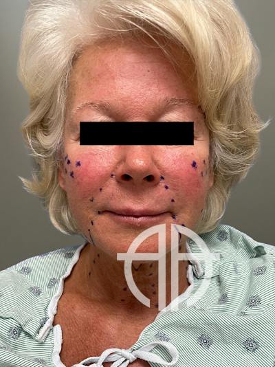FACELIFT Before & After Gallery - Patient 265475 - Image 1