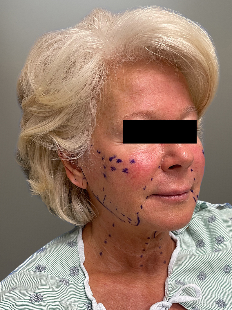 FACELIFT Before & After Gallery - Patient 265475 - Image 3