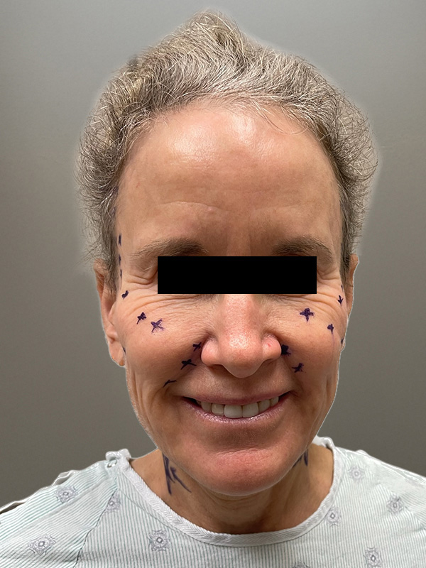 FACELIFT Before & After Gallery - Patient 266618 - Image 1