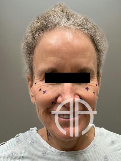 FACELIFT Before & After Gallery - Patient 266618 - Image 1