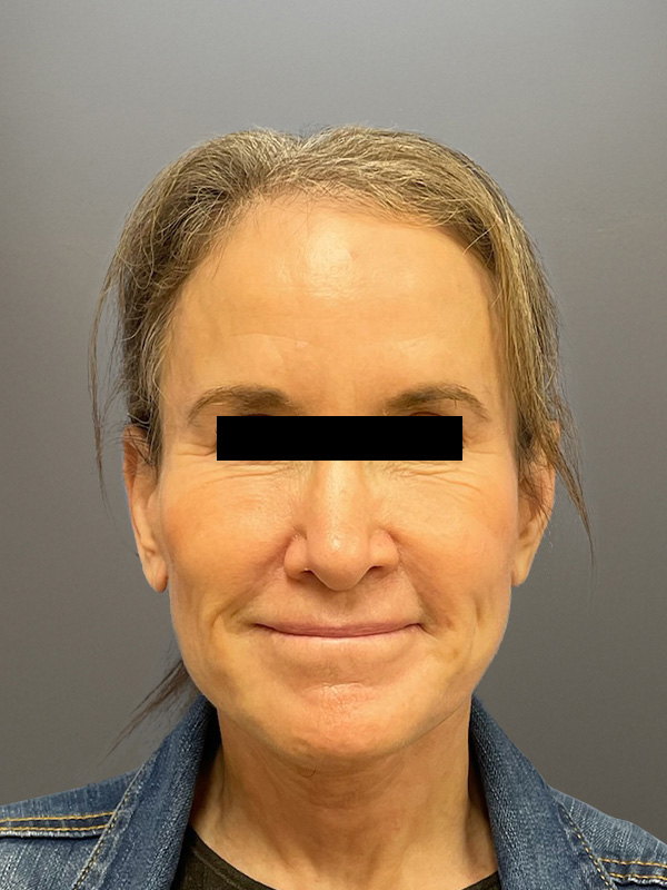 FACELIFT Before & After Gallery - Patient 266618 - Image 2