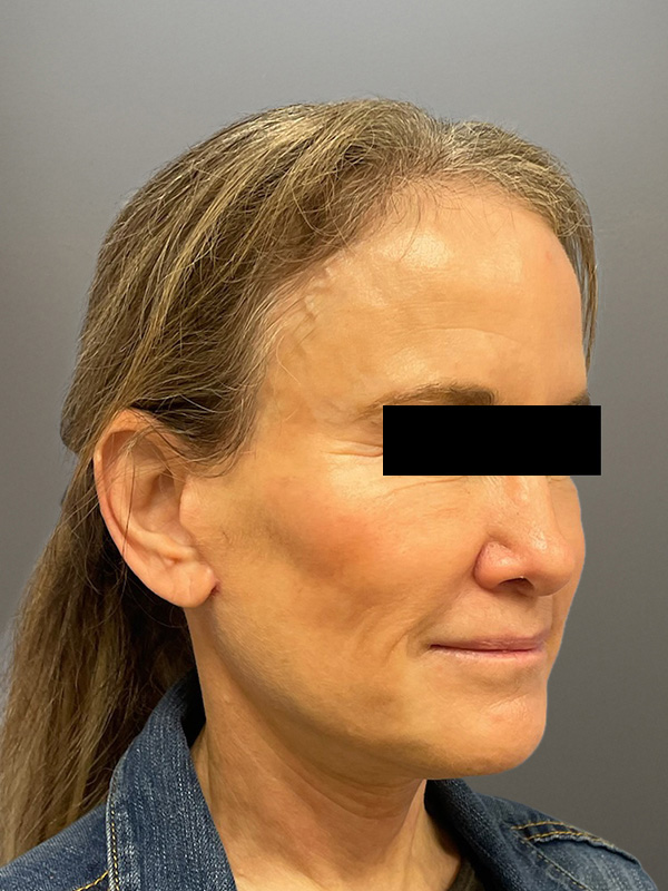FACELIFT Before & After Gallery - Patient 266618 - Image 4