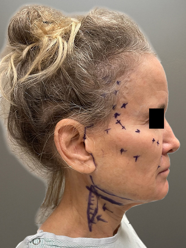 FACELIFT Before & After Gallery - Patient 266618 - Image 5
