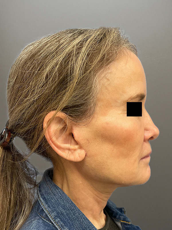 FACELIFT Before & After Gallery - Patient 266618 - Image 6
