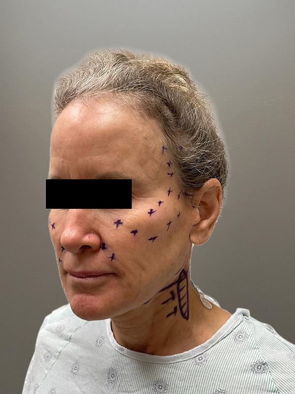 FACELIFT Before & After Gallery - Patient 266618 - Image 9