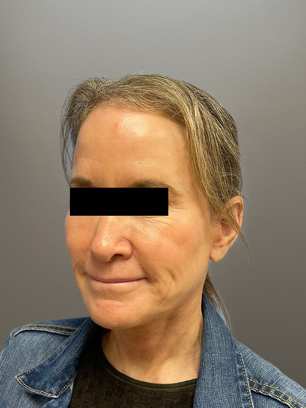 FACELIFT Before & After Gallery - Patient 266618 - Image 10