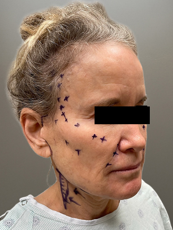 FACELIFT Before & After Gallery - Patient 266618 - Image 3