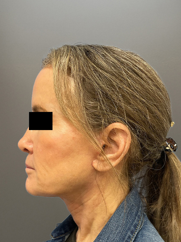 FACELIFT Before & After Gallery - Patient 266618 - Image 8