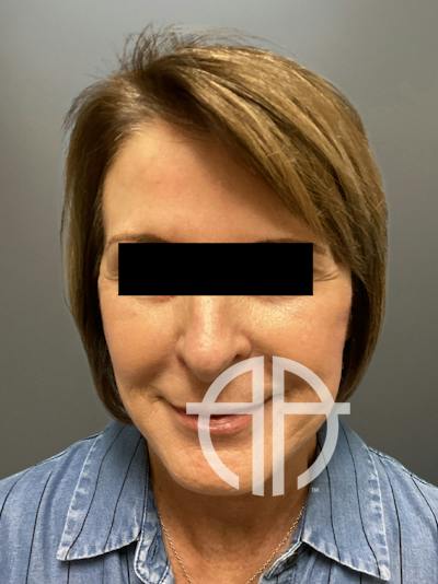 FACELIFT Before & After Gallery - Patient 273503 - Image 1