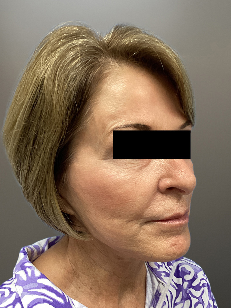 FACELIFT Before & After Gallery - Patient 273503 - Image 3