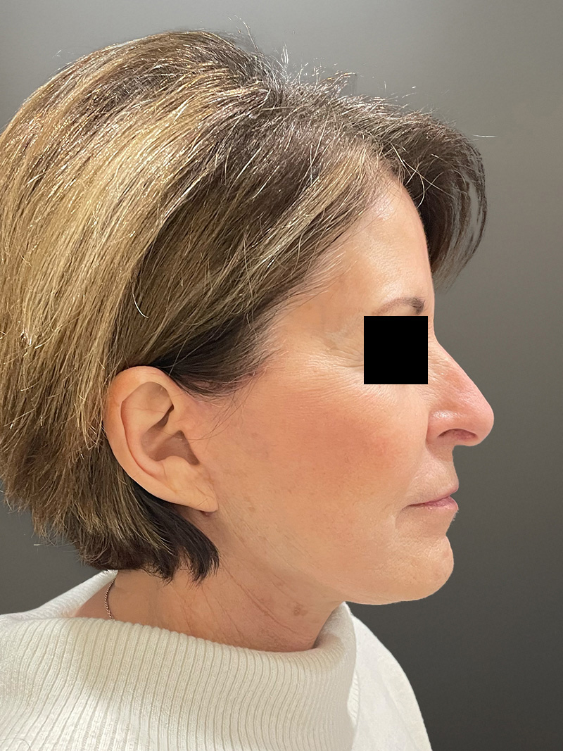 FACELIFT Before & After Gallery - Patient 273503 - Image 6
