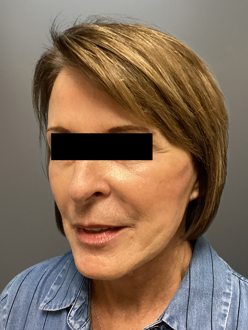 FACELIFT Before & After Gallery - Patient 273503 - Image 9