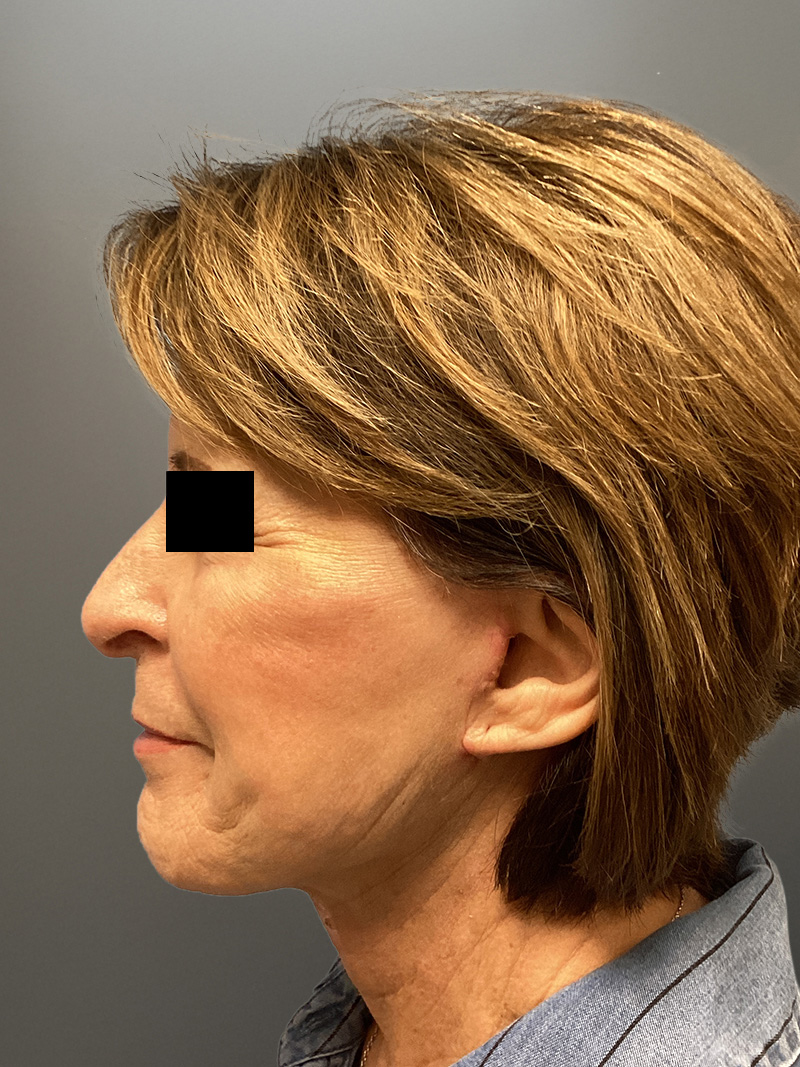 FACELIFT Before & After Gallery - Patient 273503 - Image 7