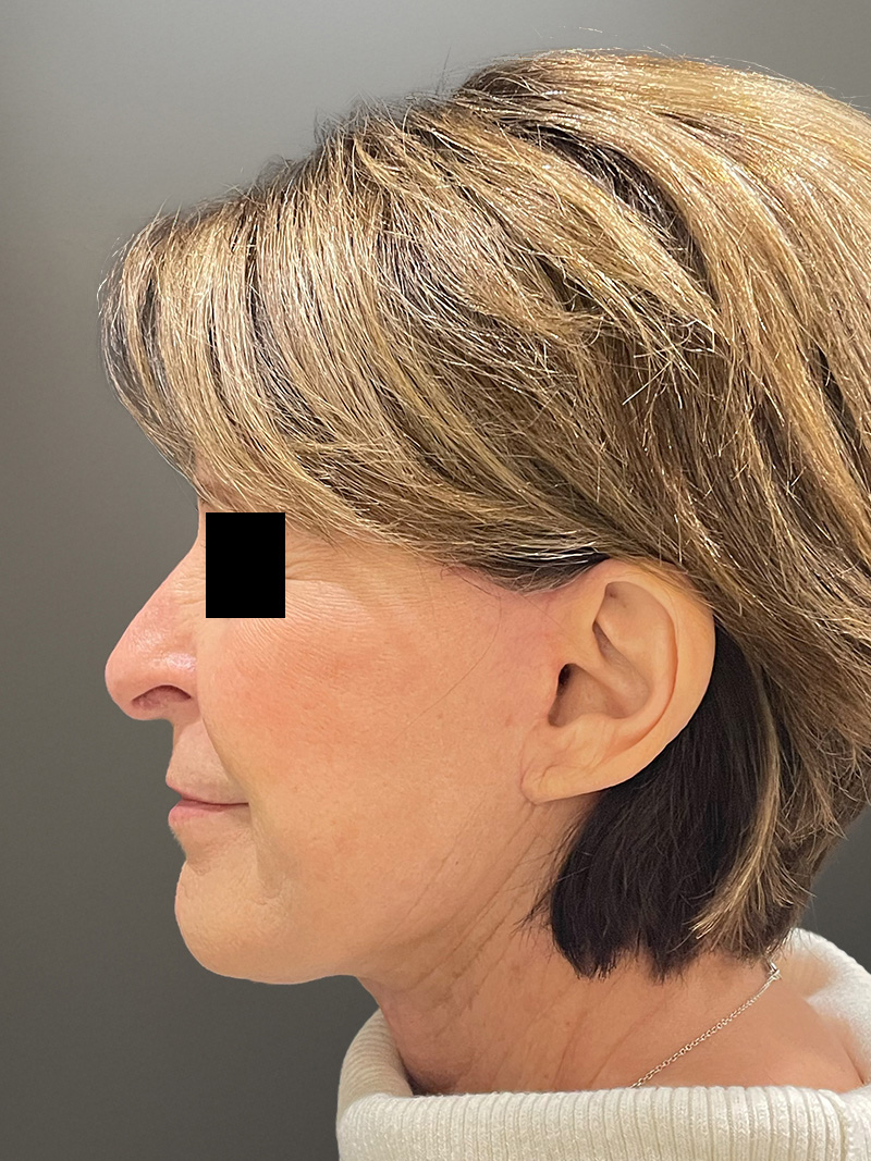 FACELIFT Before & After Gallery - Patient 273503 - Image 8