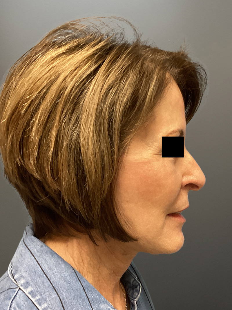 FACELIFT Before & After Gallery - Patient 273503 - Image 5