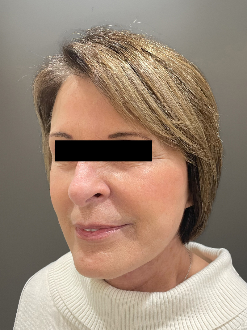 FACELIFT Before & After Gallery - Patient 273503 - Image 10