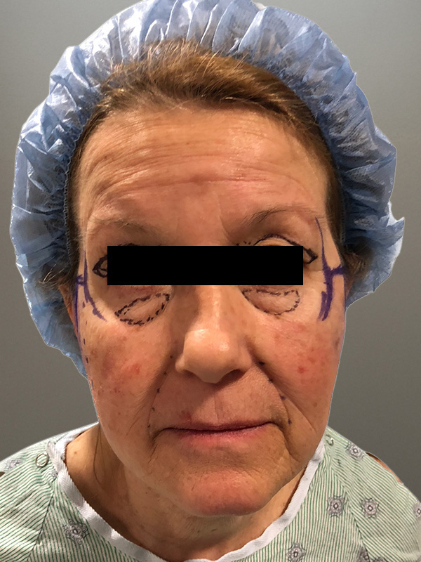 FACELIFT Before & After Gallery - Patient 362453 - Image 1