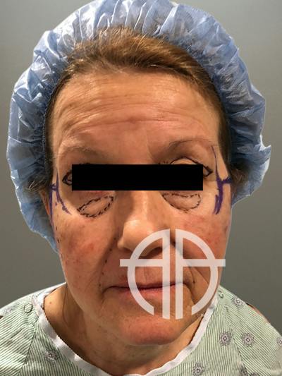 FACELIFT Before & After Gallery - Patient 362453 - Image 1