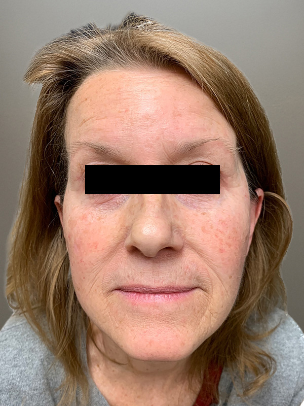 FACELIFT Before & After Gallery - Patient 362453 - Image 2