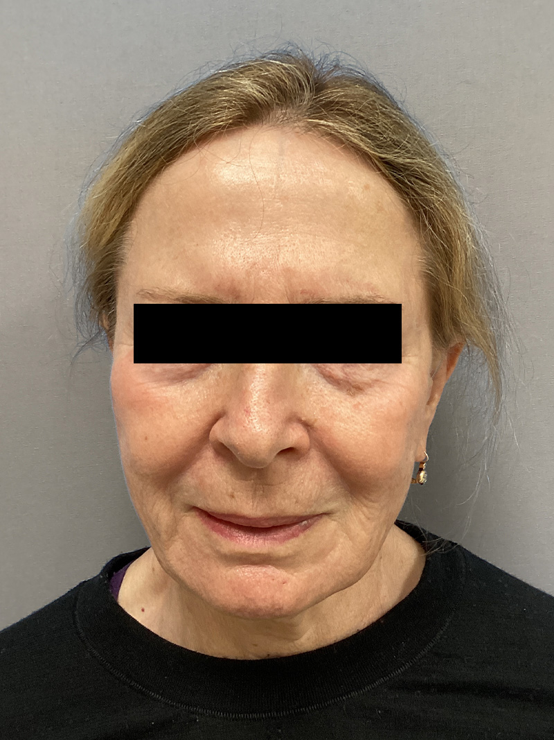 FACELIFT Before & After Gallery - Patient 427813 - Image 1