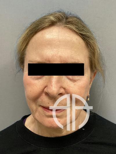FACELIFT Before & After Gallery - Patient 427813 - Image 1