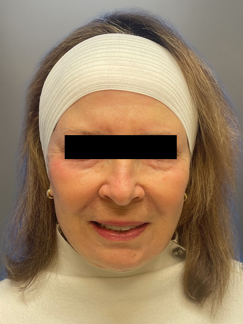 FACELIFT Before & After Gallery - Patient 427813 - Image 2