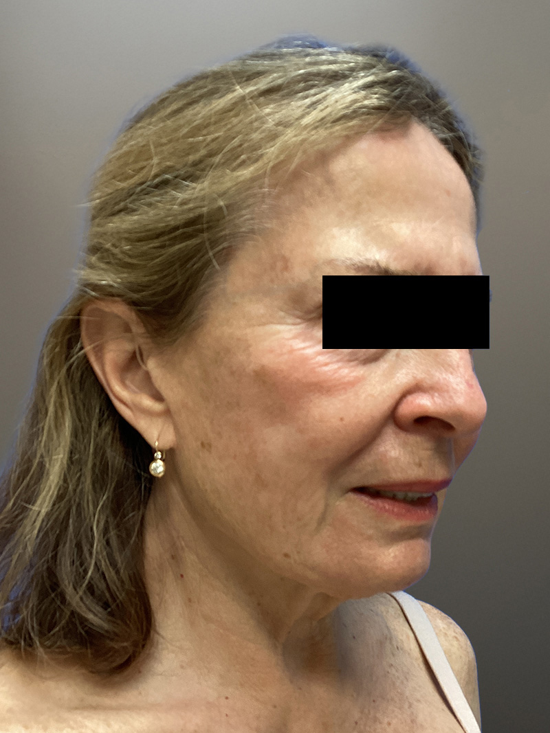 FACELIFT Before & After Gallery - Patient 427813 - Image 3