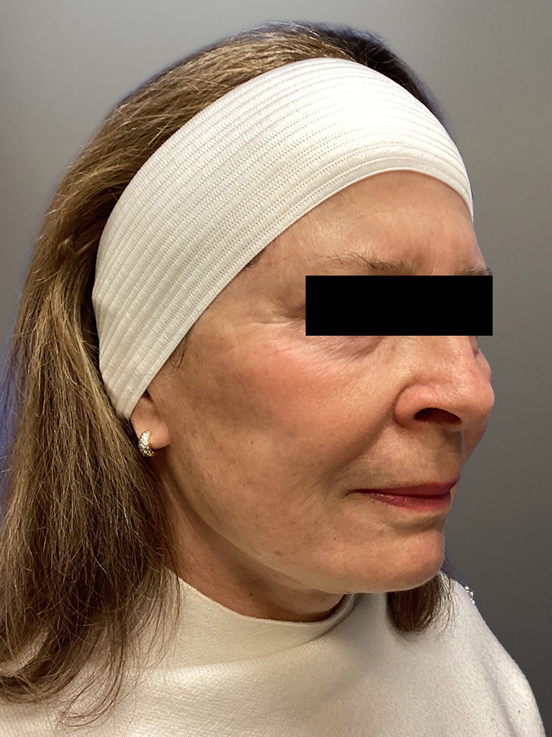 FACELIFT Before & After Gallery - Patient 427813 - Image 4