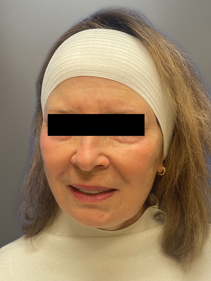 FACELIFT Before & After Gallery - Patient 427813 - Image 6