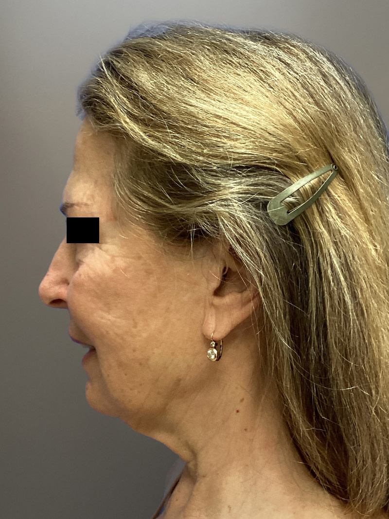 FACELIFT Before & After Gallery - Patient 427813 - Image 7