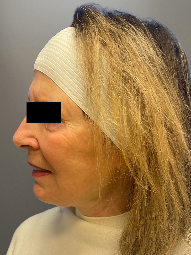 FACELIFT Before & After Gallery - Patient 427813 - Image 8