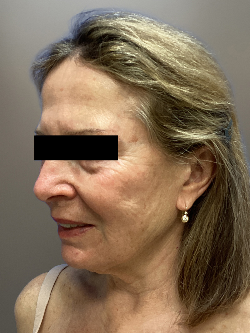 FACELIFT Before & After Gallery - Patient 427813 - Image 5