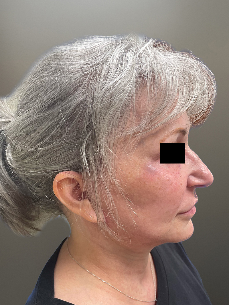 FACELIFT Before & After Gallery - Patient 680925 - Image 6